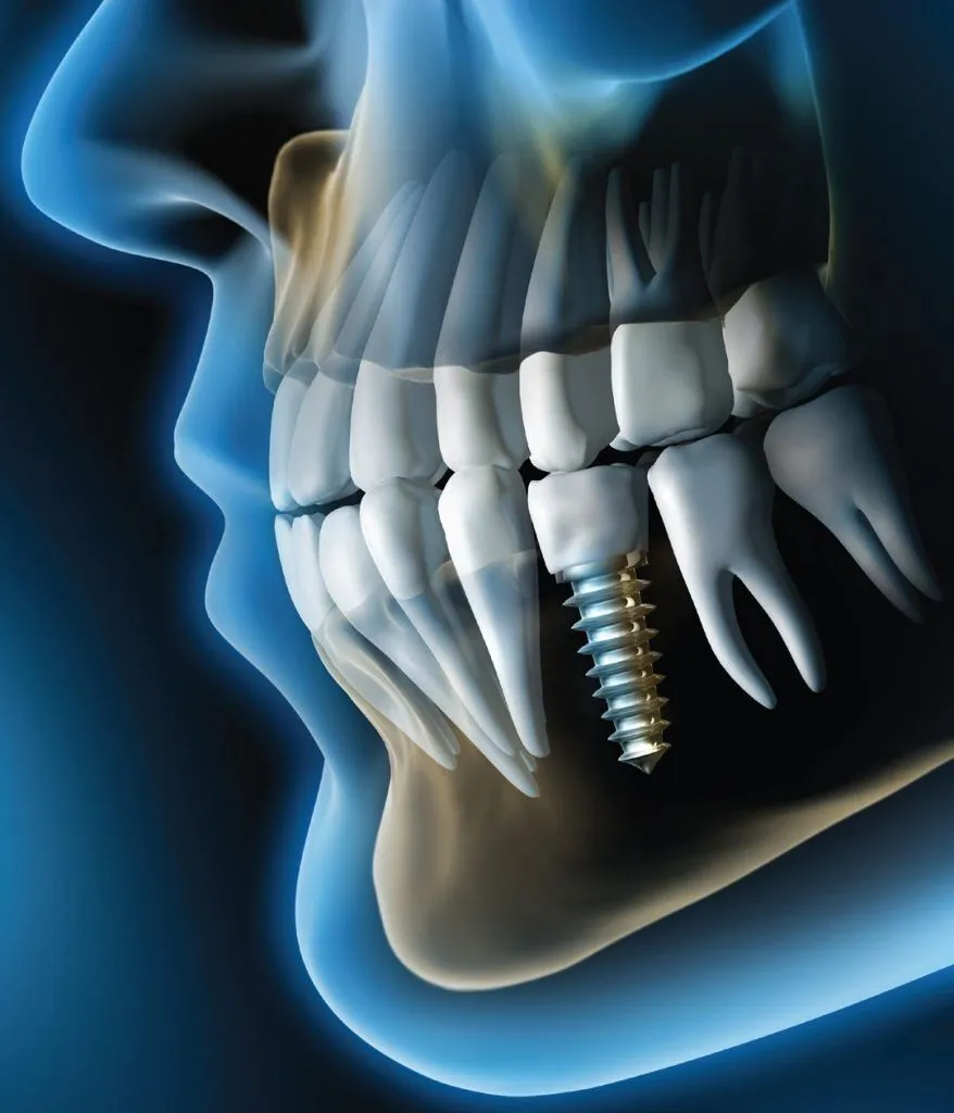 3D-Guided-Dental-Implant-Surgery-In-Dubai-878x1024