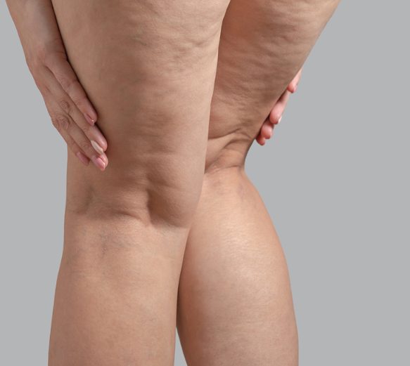 Cellulite-Reduction-Head-Picture