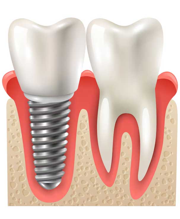 Dental-Implants-Treatment-Dubai