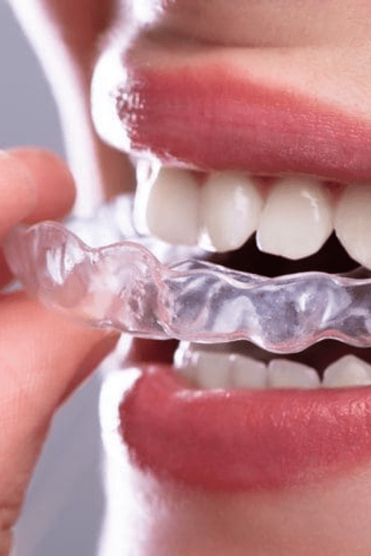 clear_aligners