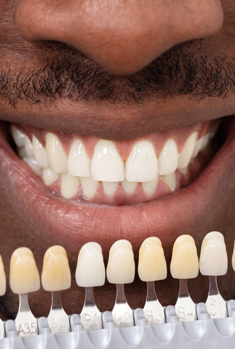 img-porcelian-veneers-1