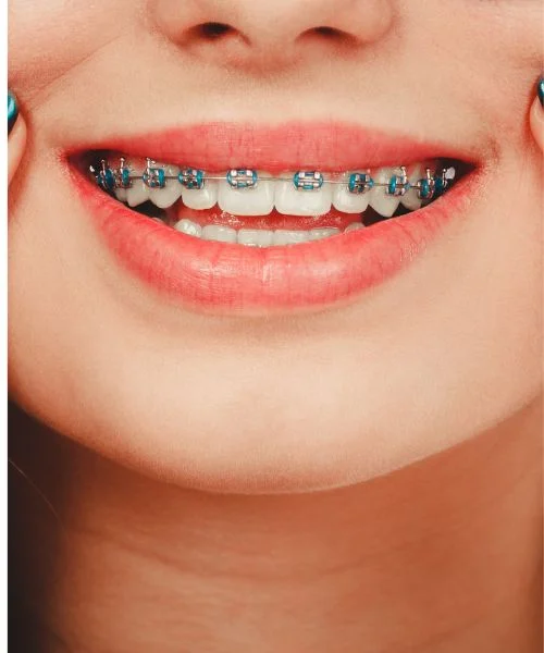 metal_braces-img-2