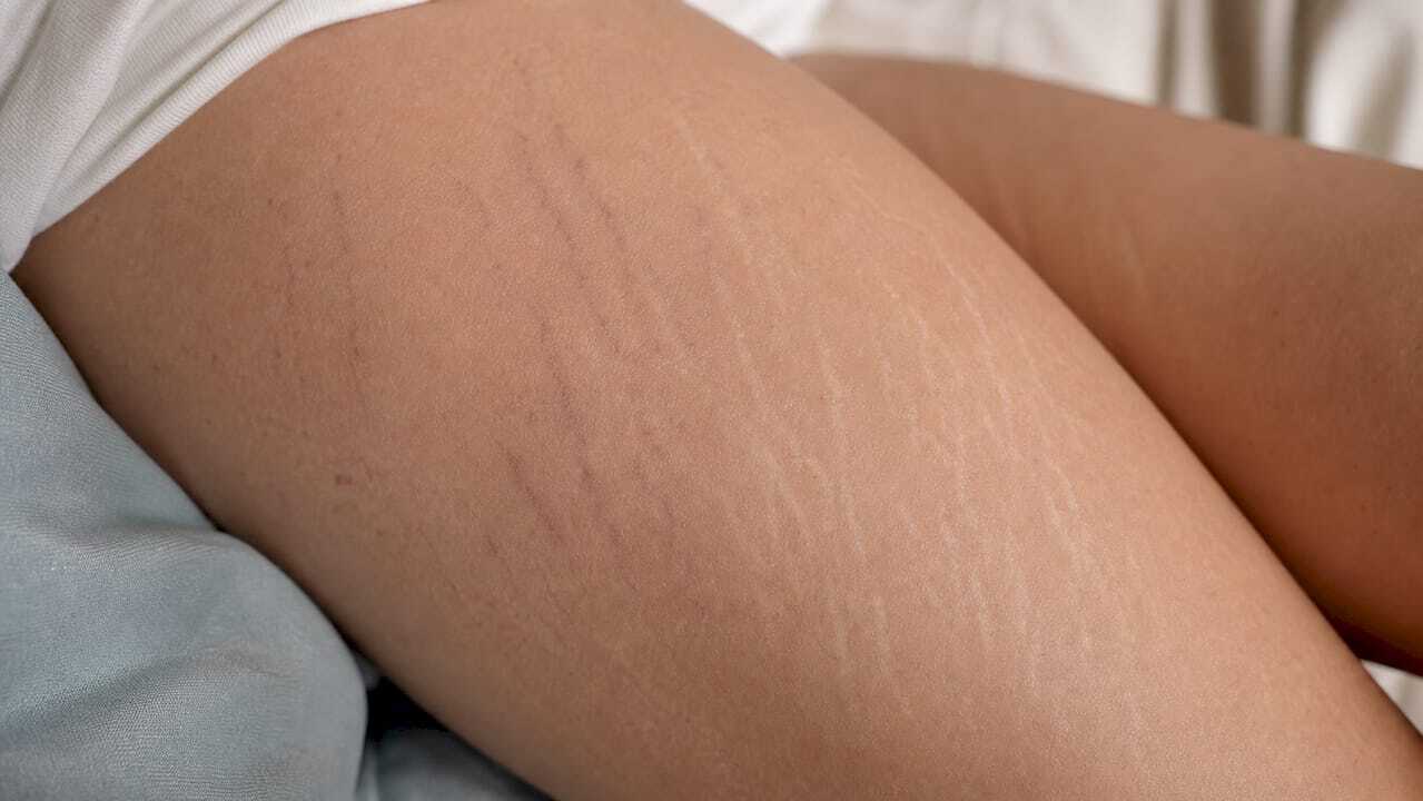 Close-up of different stretch mark stages on skin